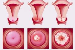 Tác hại của viêm lộ tuyến cổ tử cung