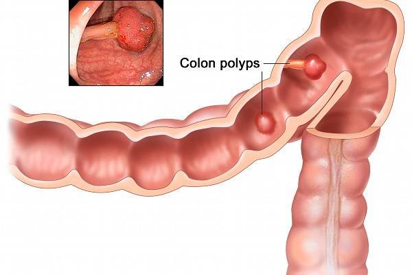 Tìm hiểu về bệnh polyp cổ tử cung