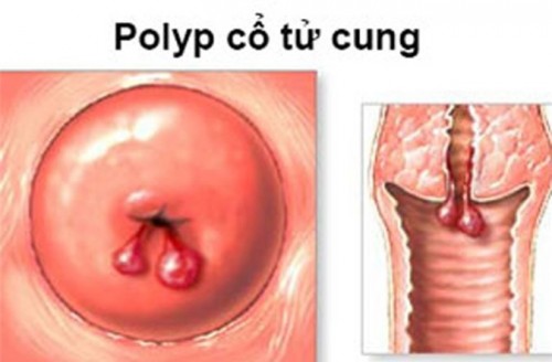 Bệnh Polyp tử cung